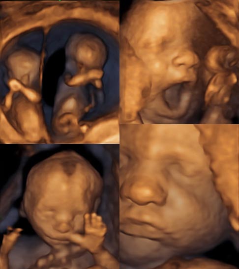 USG-prenatalne-ultrasonografia-ginekolog-lubliniec
